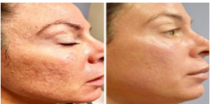 acne scar treatment in birmingham