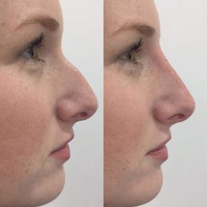 Nose reshaping in Birmingham