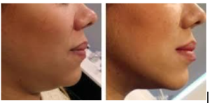 Goodbye double chin, hello jawline definition! 