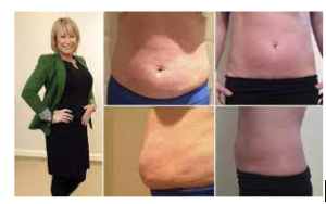 Aqualyx is for small pockets of fat and not suitable for clinically obese patients over 85kg