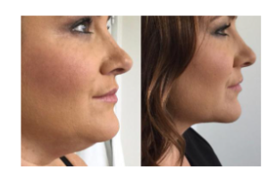 WHAT HAPPENS WHEN AQUALYX IT IS INJECTED?