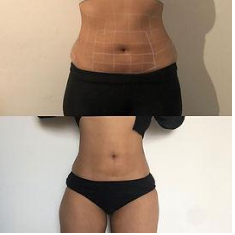 2023 01 01 15 46 09 AQUALYX FAT DISSOLVE INJECTIONS.docx Google Docs Opera