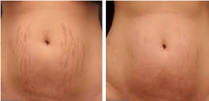 STRETCH MARKS MEDICAL MICRONEEDLING in birmingham uk