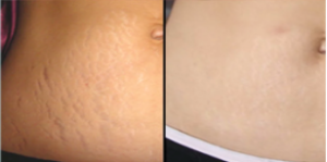 STRETCH-MARKS-MEDICAL-MICRONEEDLING