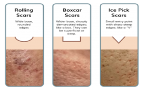 2023 01 03 13 49 51 ACNE SCAR MEDICAL MICRONEEDLING.docx Google Docs Opera