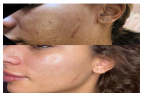 2023 01 03 13 50 08 ACNE SCAR MEDICAL MICRONEEDLING.docx Google Docs Opera