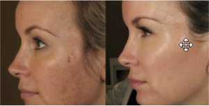 2023 01 03 13 50 59 ACNE SCAR MEDICAL MICRONEEDLING.docx Google Docs Opera