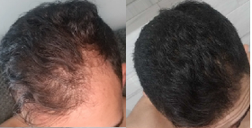 Hair Loss Follicle Restoration Therapy in birmingham