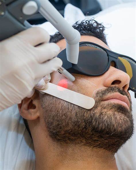 Laser for Men Hair Removal 1 Laser Hair Removal for Men Birmingham
