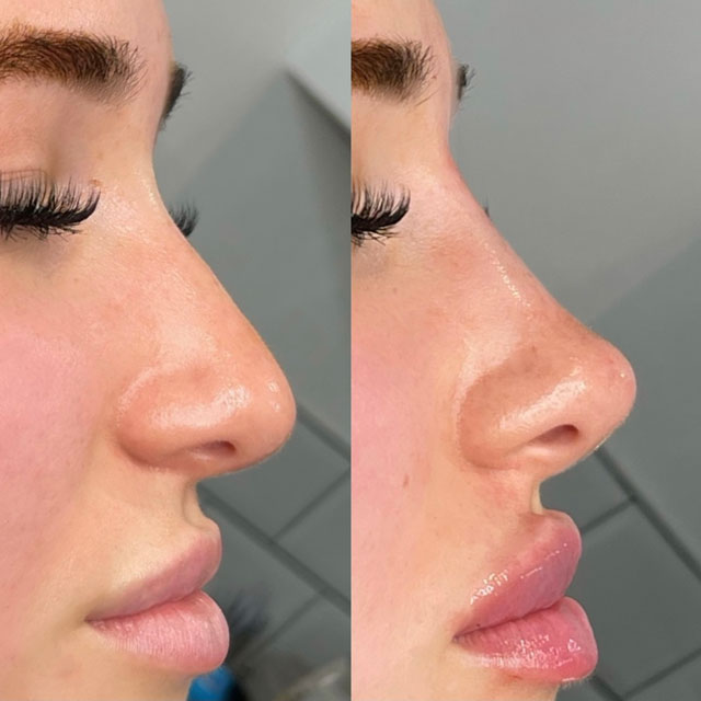 Non Surgical Rhinoplasty2