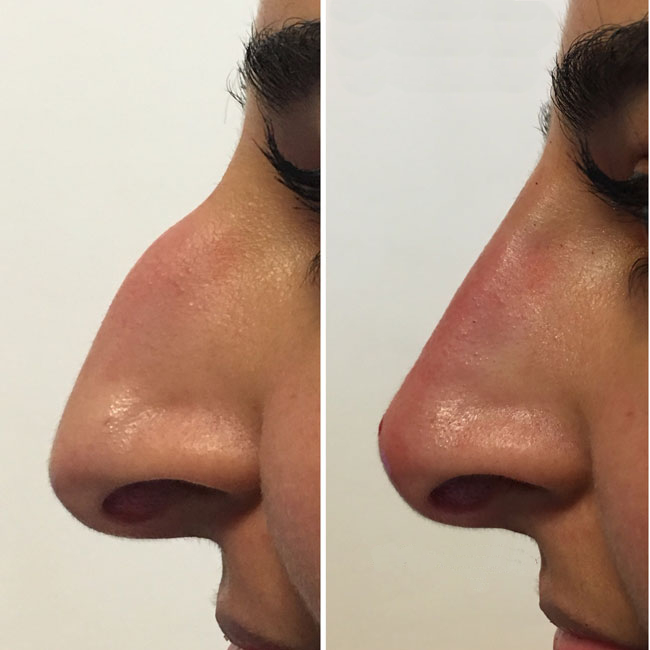 Non surg Rhinoplasty2